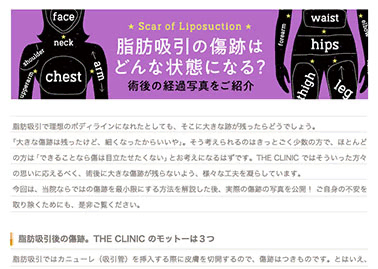 脂肪吸引の傷跡に関するコラムを公開しました。