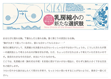 乳房縮小手術に関するコラムを公開しました。