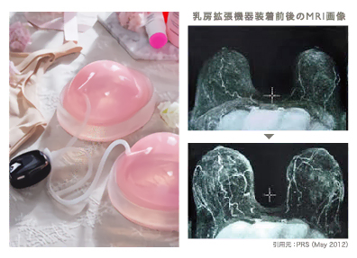 【豊胸モニター様限定】乳房拡張機器(ビブラ)を、今なら無料でお試しいただけます。