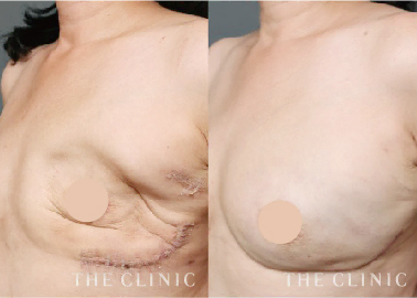 【医師対象】脂肪注入による乳房再建術の見学会のお知らせ